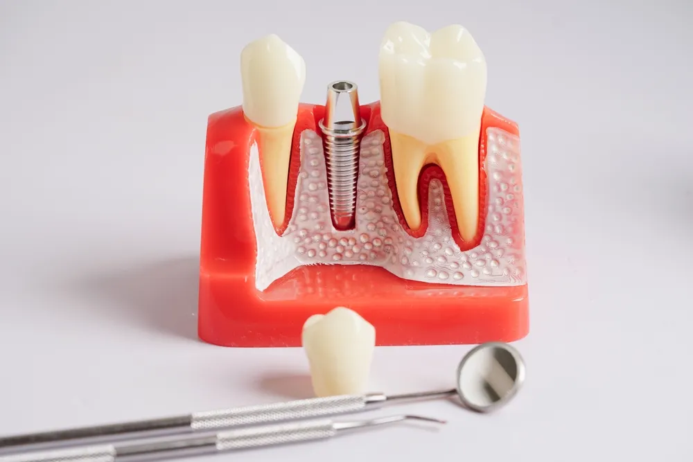 implant kimler için uygundur